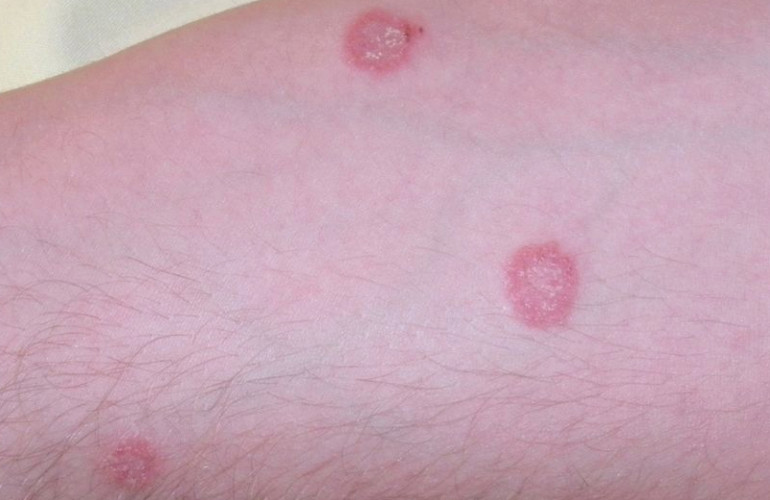 Tinea Corporis Infection a Case-Based Management Approach