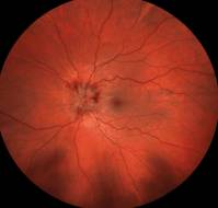 MOGAD Presenting as Optic Neuritis