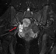 A Rare Case of Hydatid of Morgagni in a Teenager