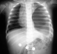 A Delayed Presentation of Congenital Diaphragmatic Hernia