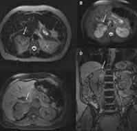 Case Report of Paraganglioma Associated with Hypertension During Pregnancy