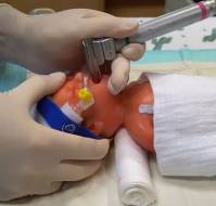 Thinner Catheter Use During Lisa can Minimize Airway Resistance in Extremely Preterm Infants