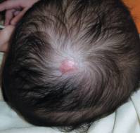 Effective Repair and Management of Severe Scalp Avulsion Sustained during Birth in an Extremely Low Birth Weight Infant