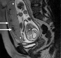 A Case Report of Using MRI for Diagnosing Placenta Accreta