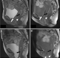 Advantages of Novel Pelvic Magnetic Resonance Imaging for Assessment Of Pelvic Organ Prolapse