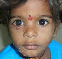 Quality of Life in Pediatric Atopic Dermatitis: A Northern India Perspective