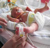 Survival of Infants in the NICU Who Were Born Between Weeks 22 and 25 of Pregnancy