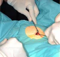 An insight into Novel technique of laparoscopic mid-urethral autologous rectus fascial sling for management of stress urinary incontinence