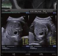 Diagnosis and management of Selective fetal growth restriction in monochorionic twin pregnancies