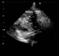 Case report: Extracorporeal Membrane Oxygenation Using a Bi-Caval Dual-Lumen Catheter in a Neonate with Persistent Pulmonary Hypertension and Interventricular Septal Hypertrophy