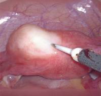 A case report of Accessory Cavitated Uterine Mass Treated with Minimally Invasive Surgery