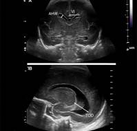 Nomograms and Reference Values for Intracranial Ventricular Dimensions in Indian Newborns