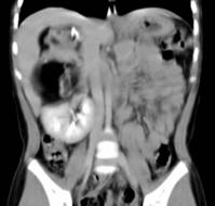 A Rare Case report of Retroperitoneal Teratoma in a Young Infant