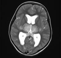 A case report ofAcute Necrotizing Encephalopathy in a Child