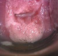 Enhancing Early Detection and Management of Cervical Glandular Neoplasia Through Colposcopy 