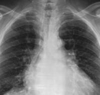 Deep Learning Analysis of Chest Radiographs for Differentiating Between Congenital Ventricular Septal Defect and Atrial Septal Defect in Children