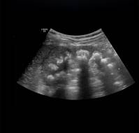 A Case Report of Atypical Presentation of Distal Renal Tubular Acidosis in a Pediatric Patient