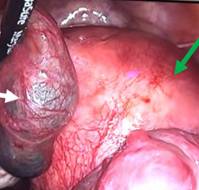 A Rare Case of Ectopic molar pregnancy