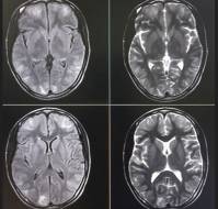 Isolated Abducens Nerve Palsy as a Rare Presentation of Scrub Typhus in a Pediatric Patient: A Case Report