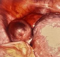 A Rare Case of a Large Ovarian Endometrioma Presenting as a Hypertensive Emergency