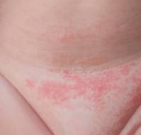 Langerhans Cell Histiocytosis Presented as Persistent Diaper Dermatitis