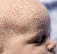 Comparison of Treatments for Infantile Seborrhoeic Dermatitis