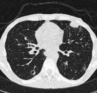 Promising Role of Ultrashort Time Echo MRI in Evaluating Lung Abnormalities in Pediatric Febrile Neutropenia