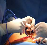 Higher Surgical Site Infection Rates After Obstetrics than Gynecology Procedures