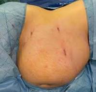 Appendectomy During Pregnancy Leading to Abdominal Wound Dehiscence 