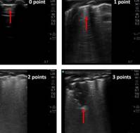 Modified Lung Ultrasound Score: An Improved Approach for Early Detection of Acute Respiratory Distress Syndrome in Pediatric Patients