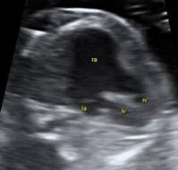 A case study of Ebstein Anomaly in Pregnancy