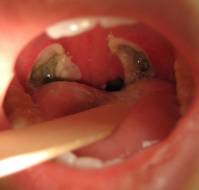 Evaluation of Pediatric Patients Undergoing Tonsillectomy for Recurrent Fever