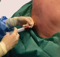A case report on the efficacy of sphenopalatine ganglion block in treating postdural puncture headaches following caesarean sections