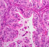 A Rare Case of Ovarian Adenocarcinoma in a 14-Year-Old Patient