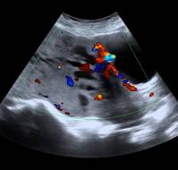 Predictors of ICU Admission in Placenta Accreta Cases