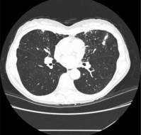 Mendelian Susceptibility to Mycobacterial Disease 