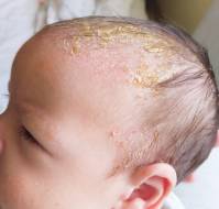 Interventions for Infantile Seborrheic Dermatitis 