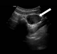 Isolated Fallopian Tube Torsion in Term Pregnancy