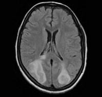 Neuroimaging Features in Eclamptic Encephalopathy 