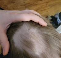 Dual Control of Alopecia Areata and Atopic Dermatitis in a Pediatric Patient Using Baricitinib
