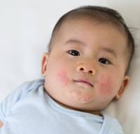 Skin Barrier Matters: A Simple Strategy to Reduce Infantile Atopic Dermatitis