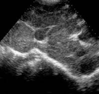 A Rare Case of Dysgerminoma in Pregnancy Presenting with Hemoperitoneum