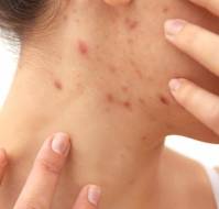 Pregnancy-Related Acne: Review and Clinical Tips