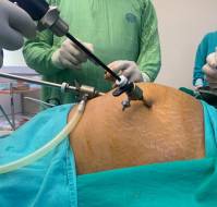 Surgical Management of Bilateral Dermoid Cysts during Caesarean Section