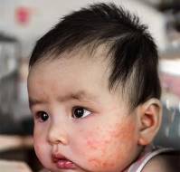 Colloidal Oat as a Preventive and Therapeutic Emollient for Infant AD