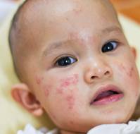 Periorificial Dermatitis in Early Childhood: Insights from a Narrative Review