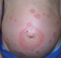 Managing Dermatoses of Pregnancy: Focus on ICP and PPP