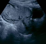 Placenta Accreta Spectrum – A Case Highlighting the Need for Early Diagnosis and Multidisciplinary Management
