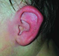 A Case of Pediatric Red Ear Syndrome Misidentified as Polychondritis
