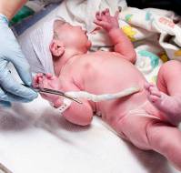 Neonatal and Maternal Outcomes of Varying Cord Clamping Times in Cesarean Sections